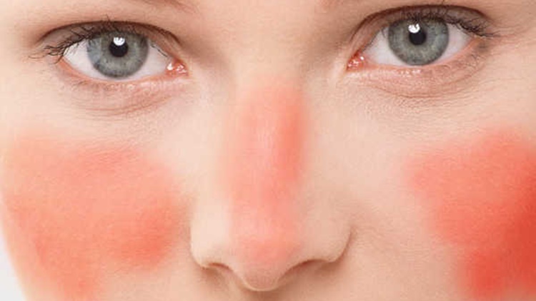 rosacea