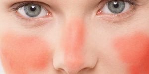 rosacea