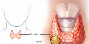 tireoidite linfocítica