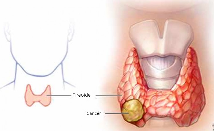 tireoidite linfocítica