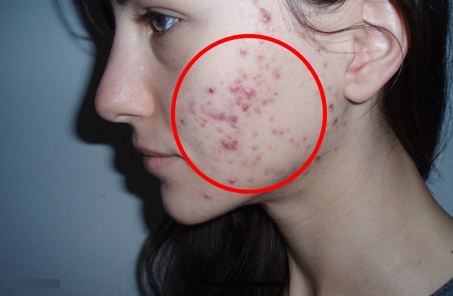 Remédios caseiros para tratar acne cística: como usar, dicas e receitas