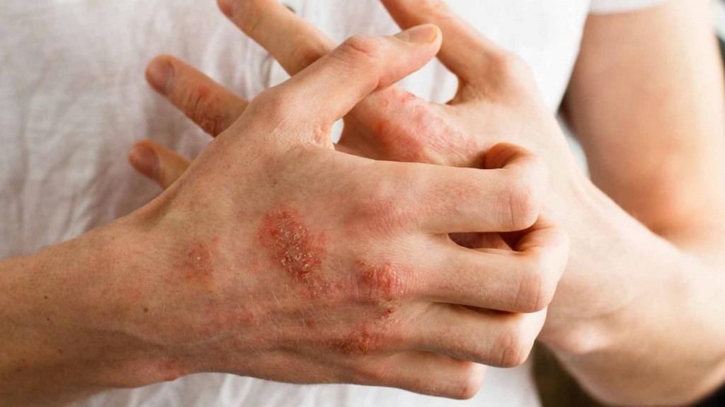 Como usar óleo da árvore do chá para tratar eczema? receitas e dicas