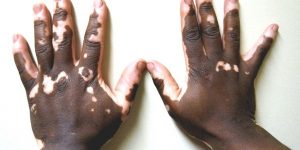 vitiligo