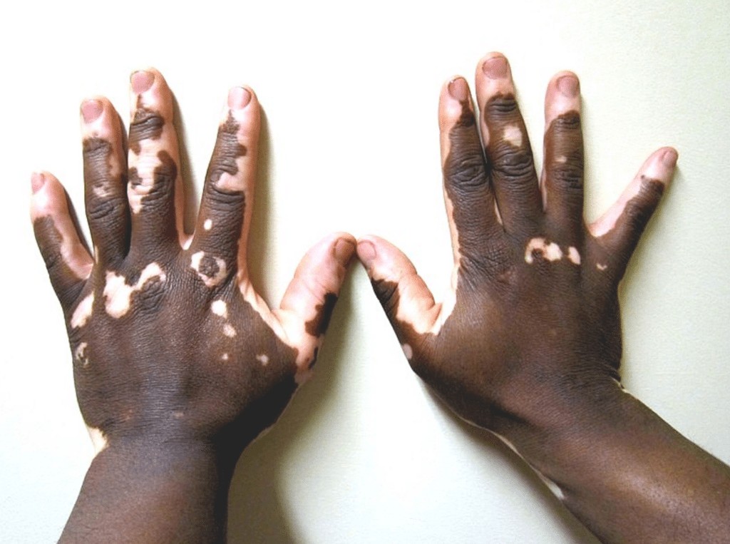 vitiligo