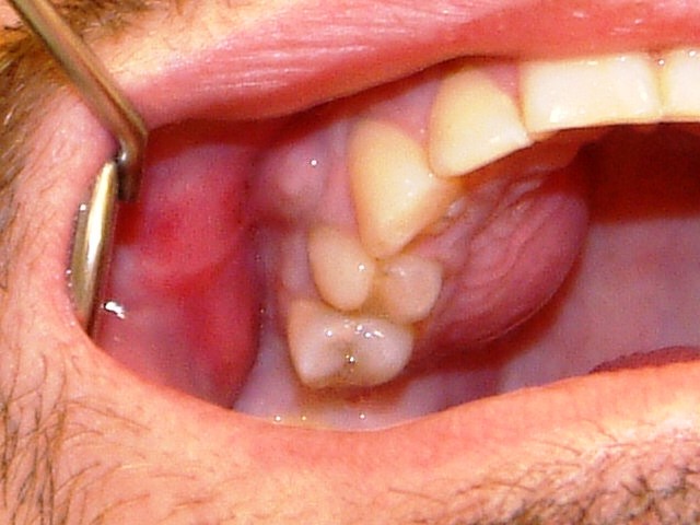 Abscesso dentário: o que é, causas, sintomas e tratamentos