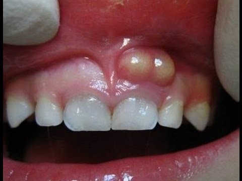 abscesso dentario