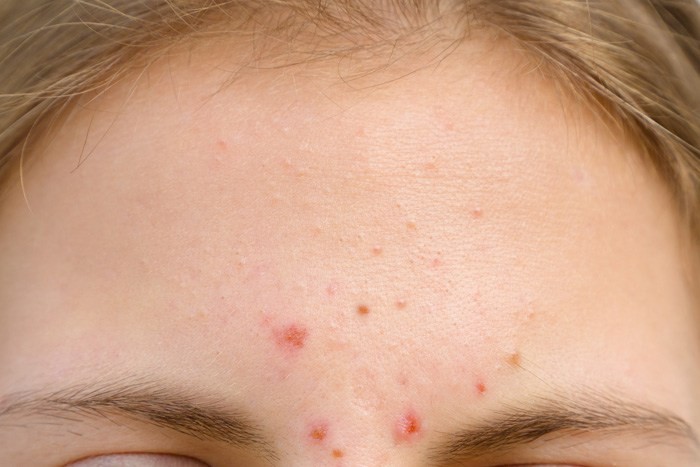 4 receitas caseiras para acabar com a acne naturalmente: como fazer e dicas