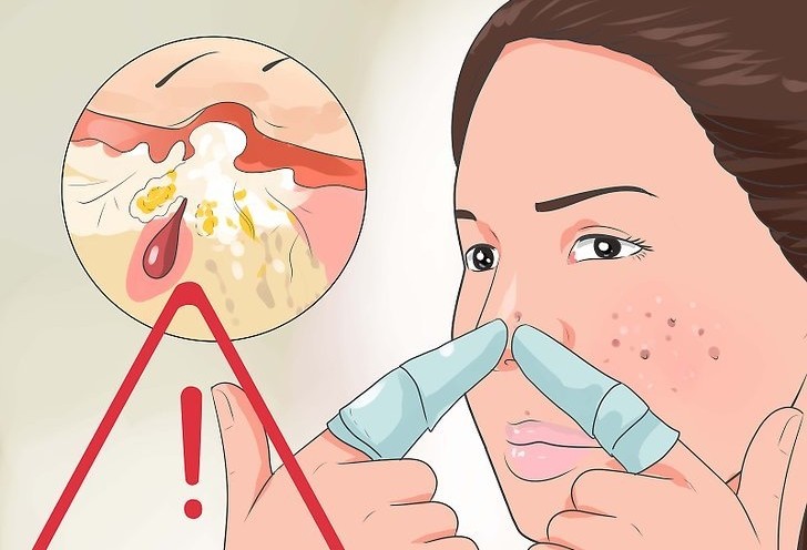 dicas caseiras para eliminar acne naturalmente
