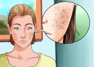 Acne: 8 óleos que ajudam a remove-las, dicas e passo a passo