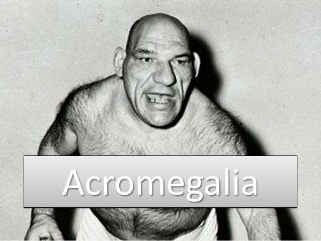 acromegalia o que e