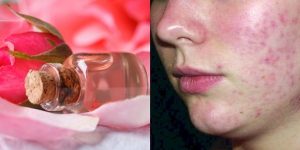 beneficios da agua de rosas para acne