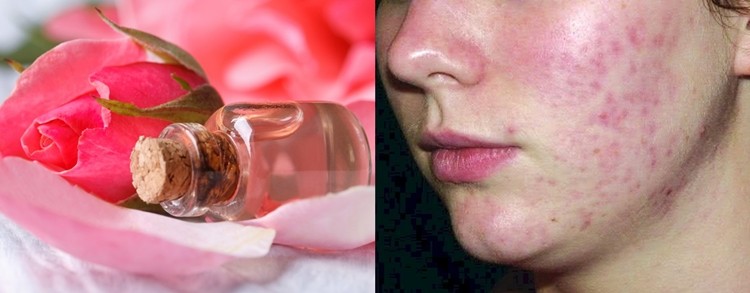 beneficios da agua de rosas para acne
