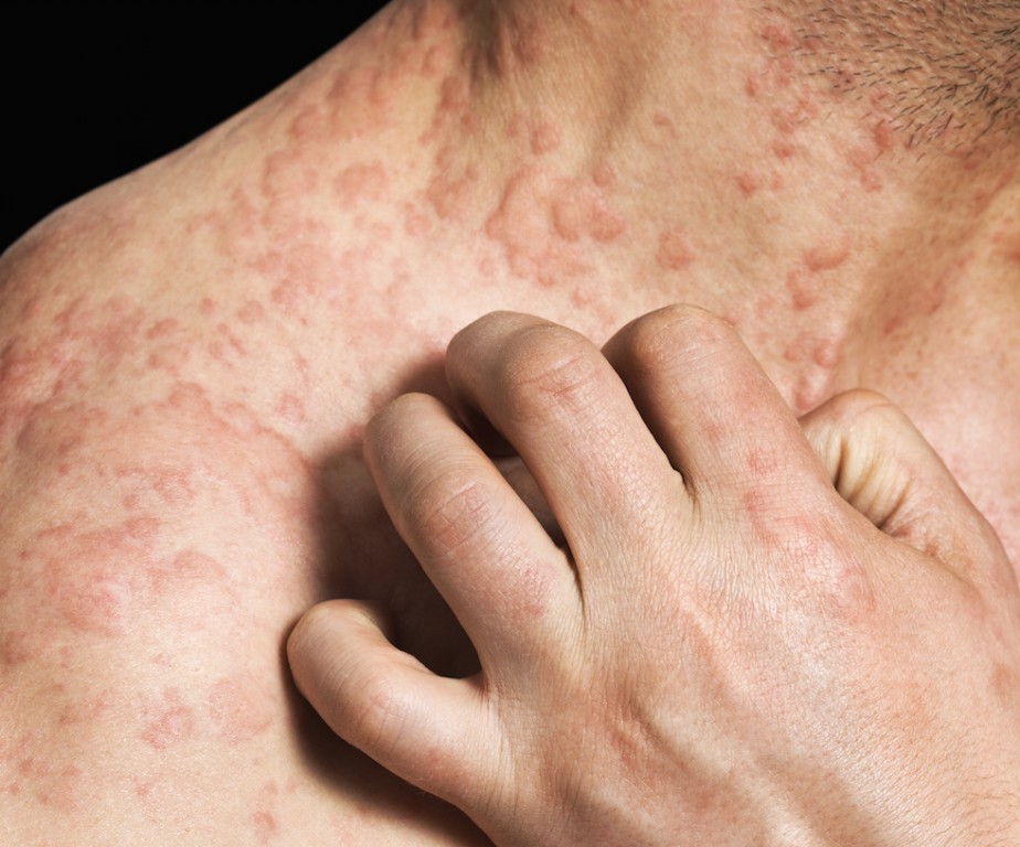 Alergia: o que é, sintomas, causas e tratamentos