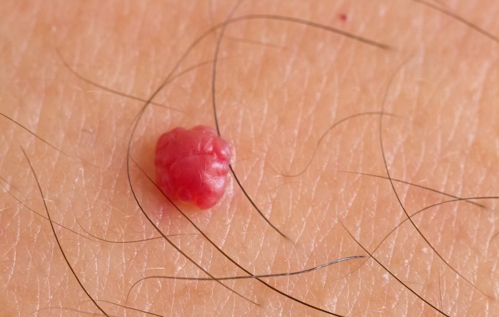 Angioma: o que é, causas, sintomas e tratamentos