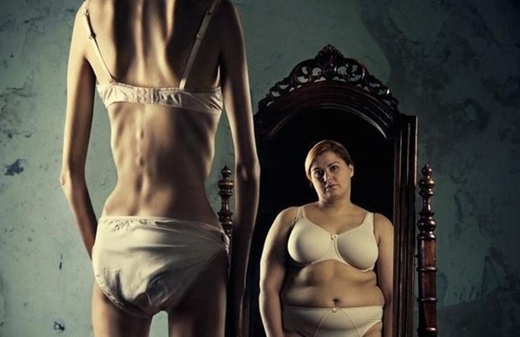 anorexia nervosa