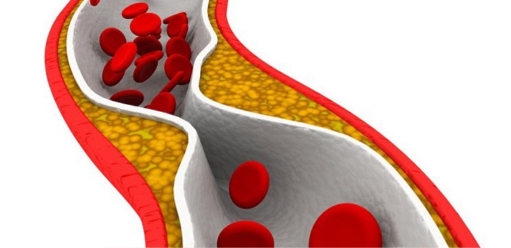 Aterosclerose: o que é, causas, sintomas e tratamentos