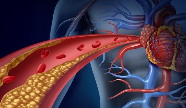 Aterosclerose - o que é, causas, sintomas e tratamentos ...