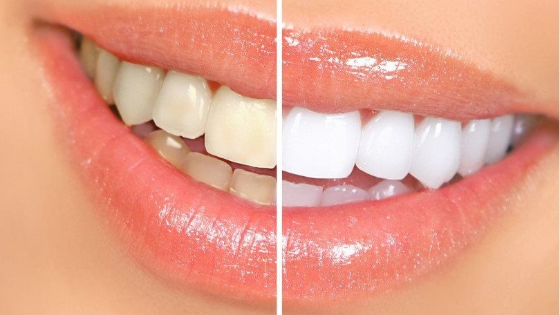 Maneiras naturais de branquear os dentes: como fazer, dicas e receitas