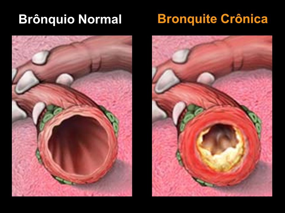 Bronquite crônica: o que é, causas sintomas e tratamento