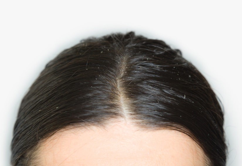 10 dicas para eliminar cabelos oleosos naturalmente