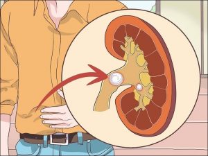 Cálculo renal: o que é, causas, tratamento e prevenção