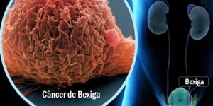 cancer de bexiga o que e