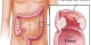 o que é câncer de intestino