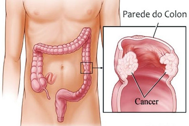 o que é câncer de intestino