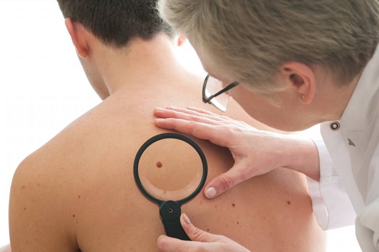 Os 4 sinais para você identificar o câncer de pele