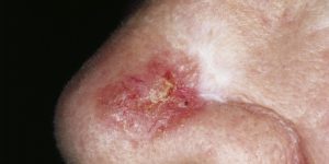 carcinoma basocelular