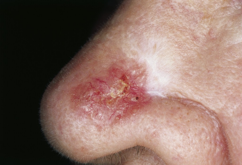 carcinoma basocelular