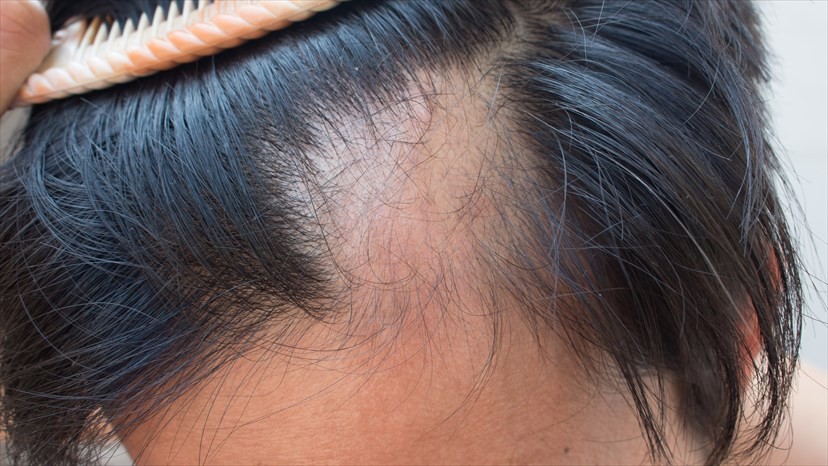 5 primeiros sinais de alopecia e como prevenir