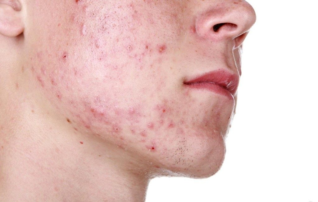 4 receitas caseiras para acabar com a acne naturalmente: como fazer e dicas