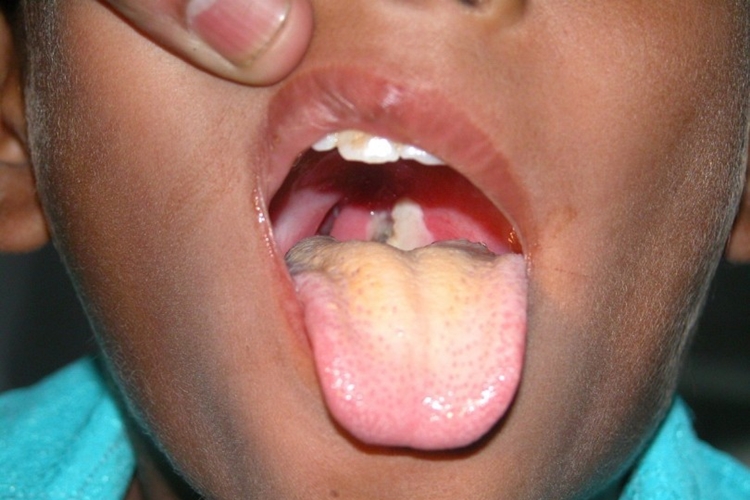 Difteria: o que é, causas, sintomas e tratamentos