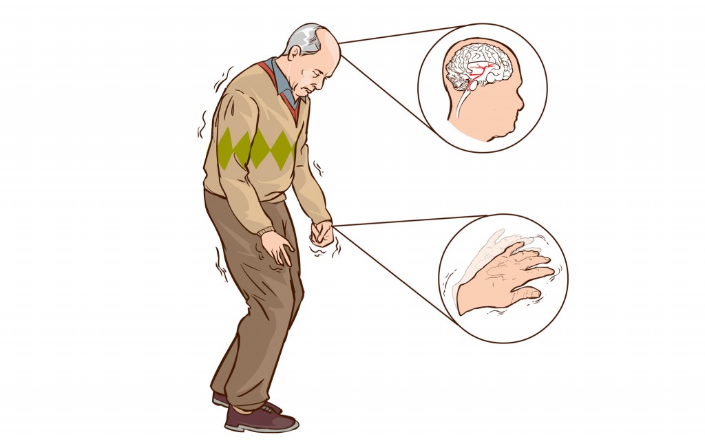 Doença de parkinson: o que é, sintomas, causas e tratamentos