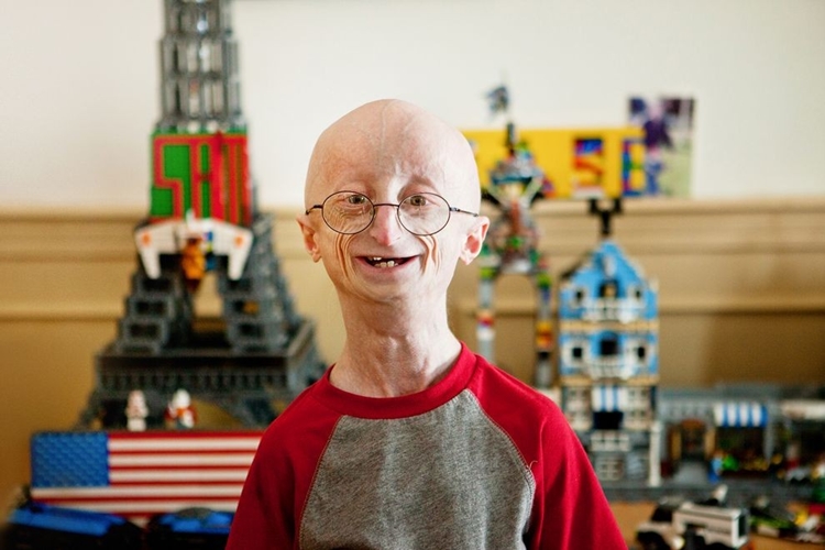 causas da progeria