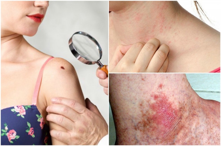 sinais para você identificar o câncer de pele