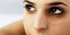 6 dicas para eliminar os círculos escuros sob os olhos que todos usam