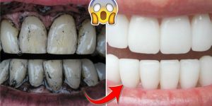 remédios caseiros para clarear os dentes naturalmente