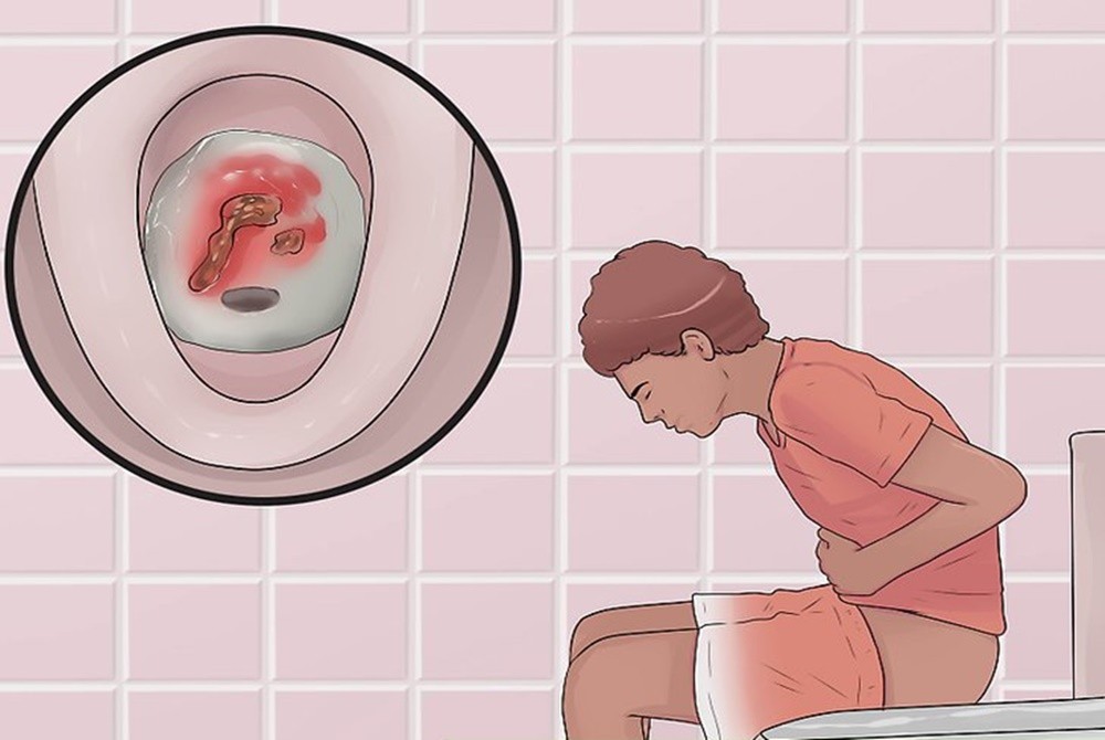 Colite ulcerativa: o que é, sintomas e tratamentos