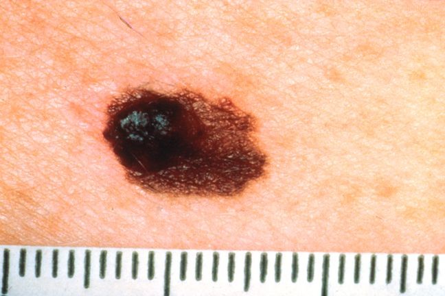 Câncer de pele: como identificar rapidamente? 5 sintomas comuns