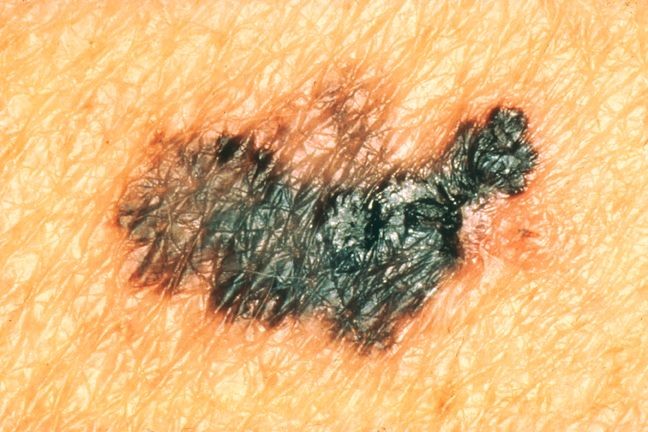 Câncer de pele: como identificar rapidamente? 5 sintomas comuns