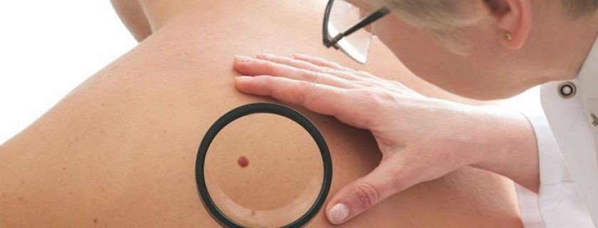 como identificar o cancer de pele