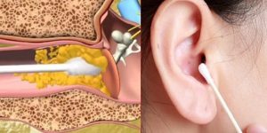 maneiras simples de remover a cera do ouvido