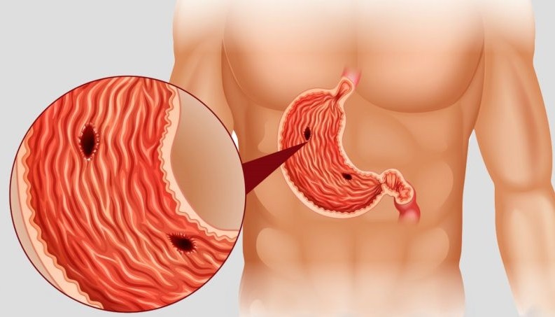 como tratar úlcera de estômago naturalmente?