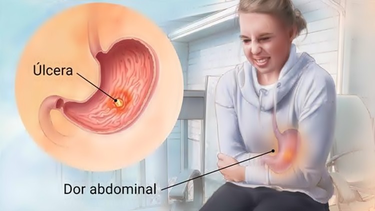 como tratar úlcera gástrica rapidamente?