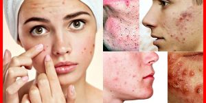 cuidados com a pele para prevenir a acne cistica