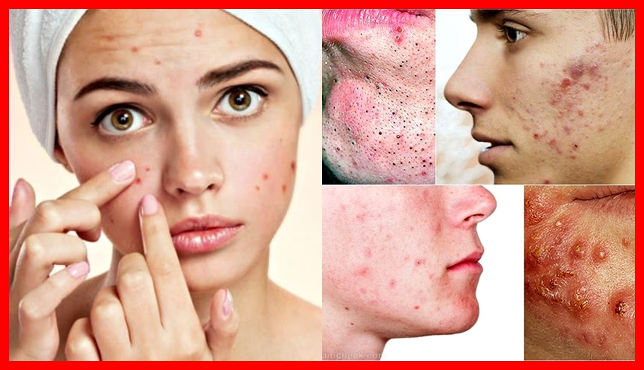 cuidados com a pele para prevenir a acne cistica