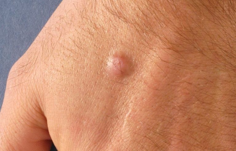 Dermatofibroma - O que é, Causas, Sintomas e Tratamentos! | Cura Natural