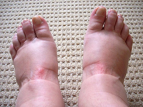 6 dicas caseiras para curar edema nas pernas: funciona? como fazer?